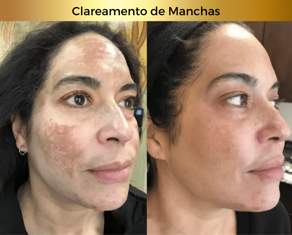 Antissinais - Efeito Botox (1)