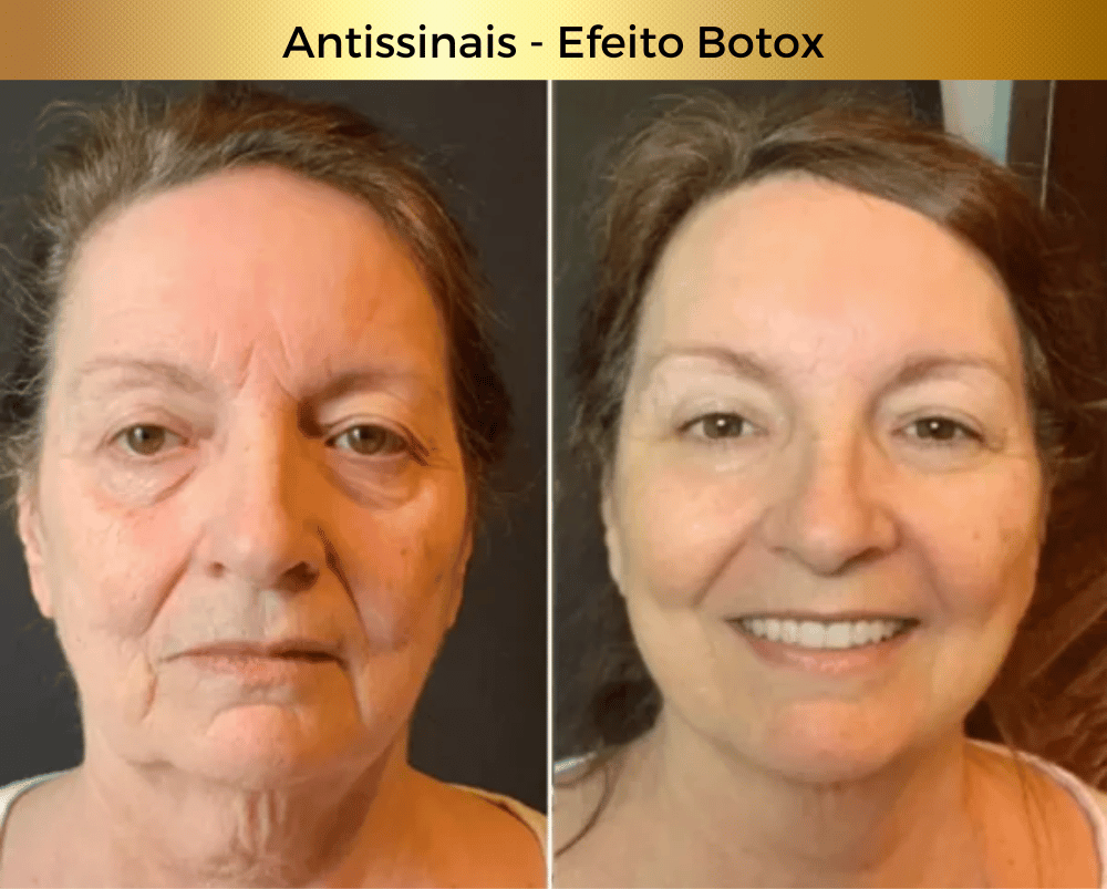 Antissinais - Efeito Botox