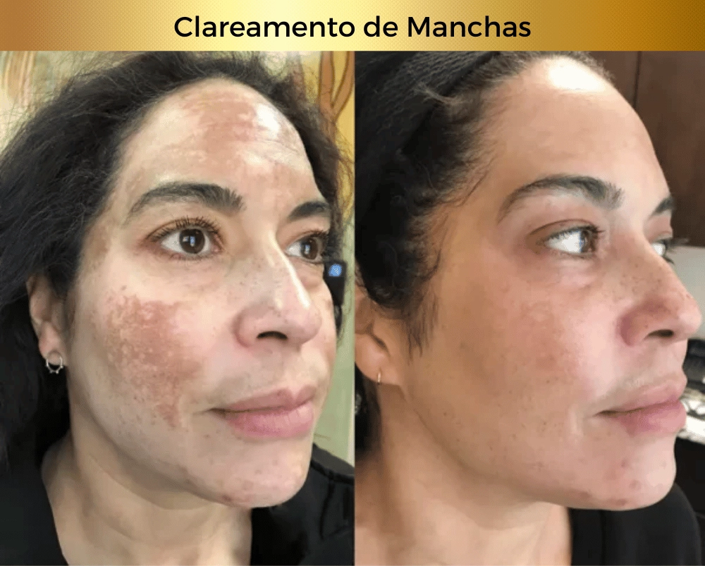 Antissinais - Efeito Botox (1)